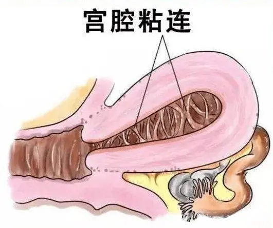  宫腔粘连